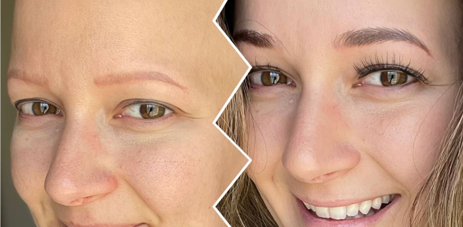 Best Eyebrow Replacement Solutions